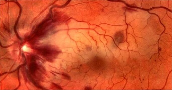 blood vessels of the retina and restoration of vision
